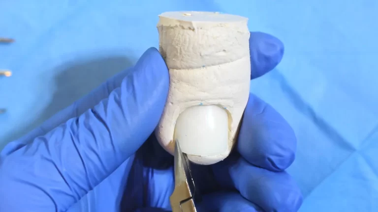 espiculaectomia alicate podologia