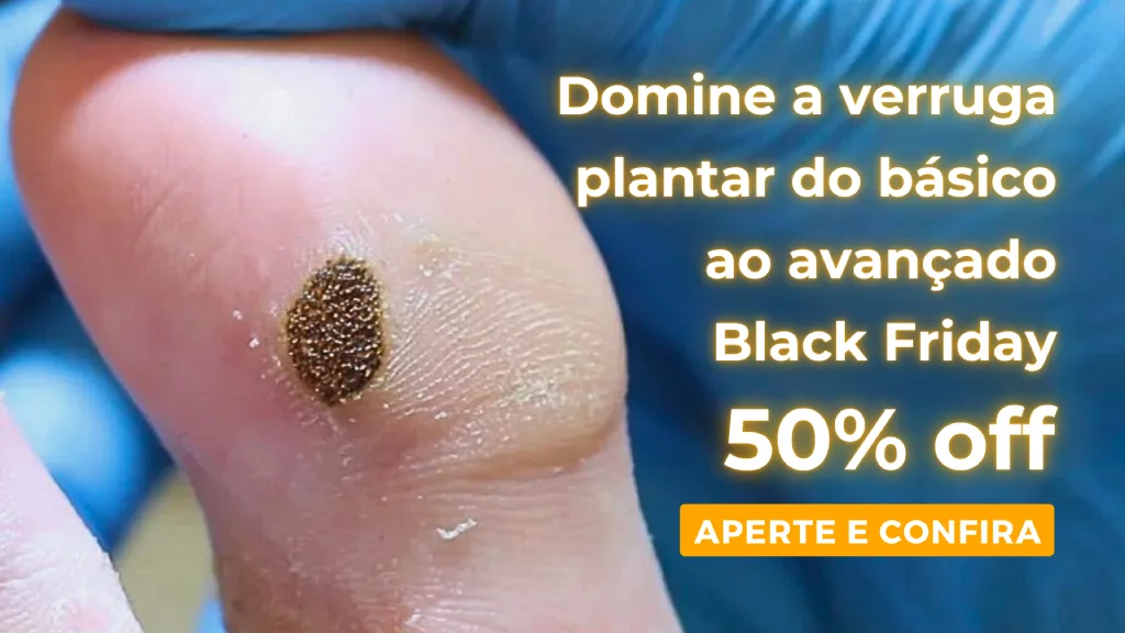 banner curso verruga plantar podologia black friday