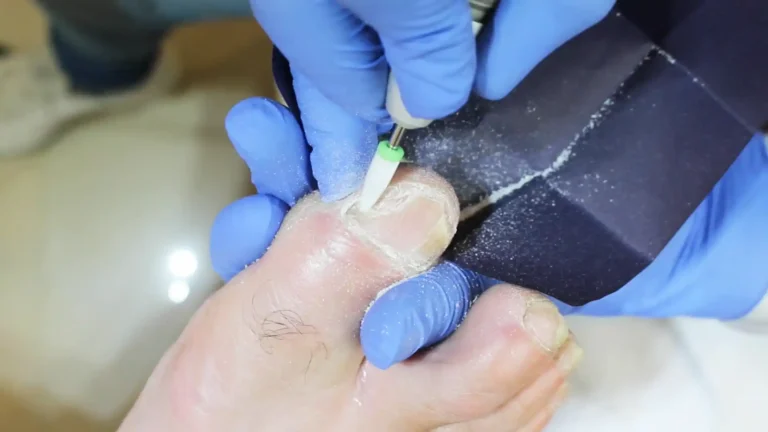 exame micologico podologia coleta fresa