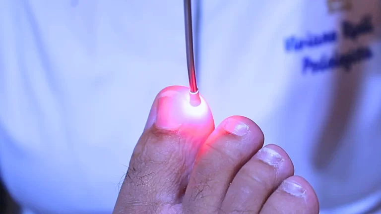 laser halux direito onicomicose podologia