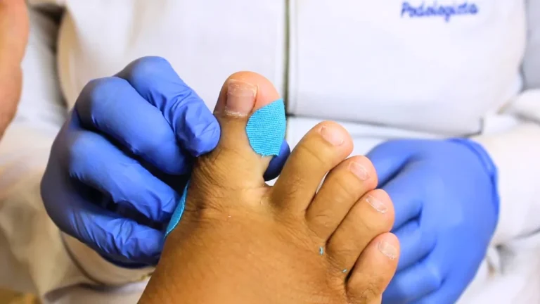 onicoortese bandagem onicocriptose