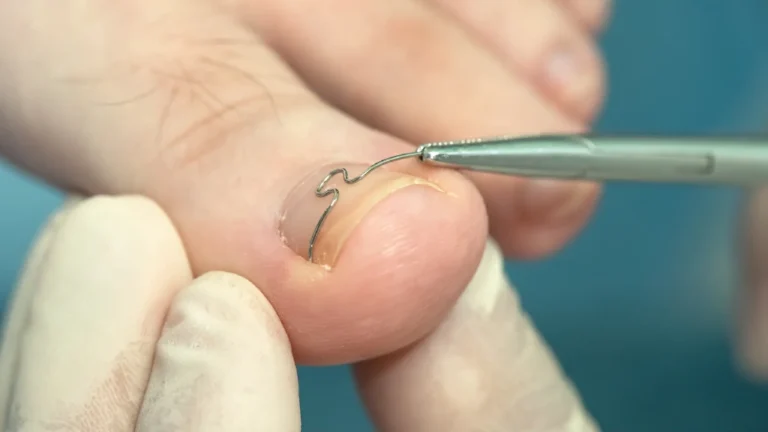 ortese ungueal fio metalico