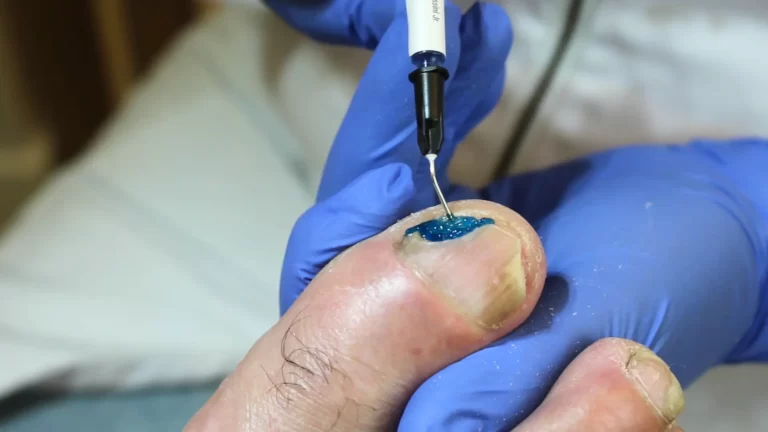 unha halux onicomicose azul metileno
